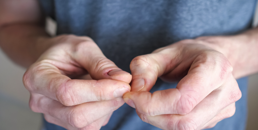 dłonie mężczyzny który ma zaburzenie zwane neuroza